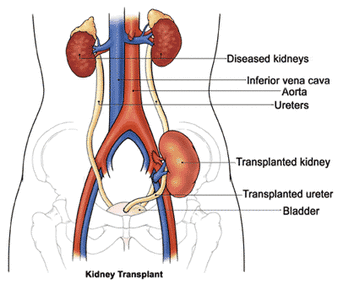 Diagram of a Kidney Transplant